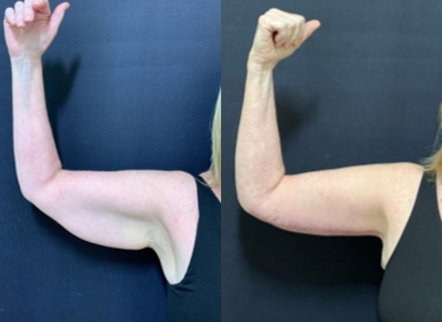 Arm Lift Before & After Photo | San Francisco, CA | Kaiser Permanente Cosmetic Services