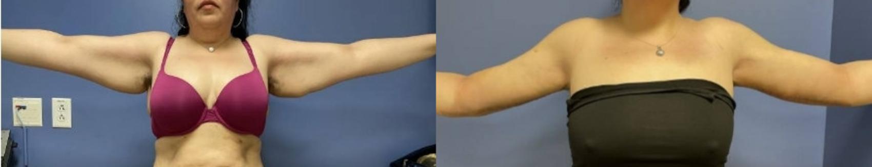 Arm Lift Before & After Photo | San Francisco, CA | Kaiser Permanente Cosmetic Services