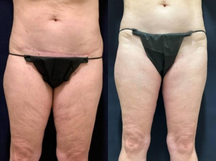 Body Contouring Before & After Photo | San Francisco, CA | Kaiser Permanente Cosmetic Services