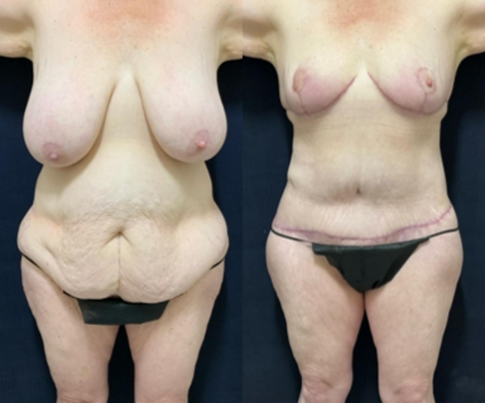 Breast Reduction Before & After Photo | San Francisco, CA | Kaiser Permanente Cosmetic Services