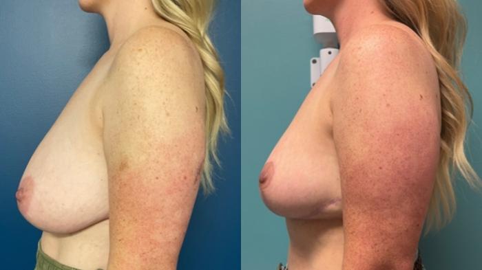 Breast Reduction Before & After Photo | San Francisco, CA | Kaiser Permanente Cosmetic Services