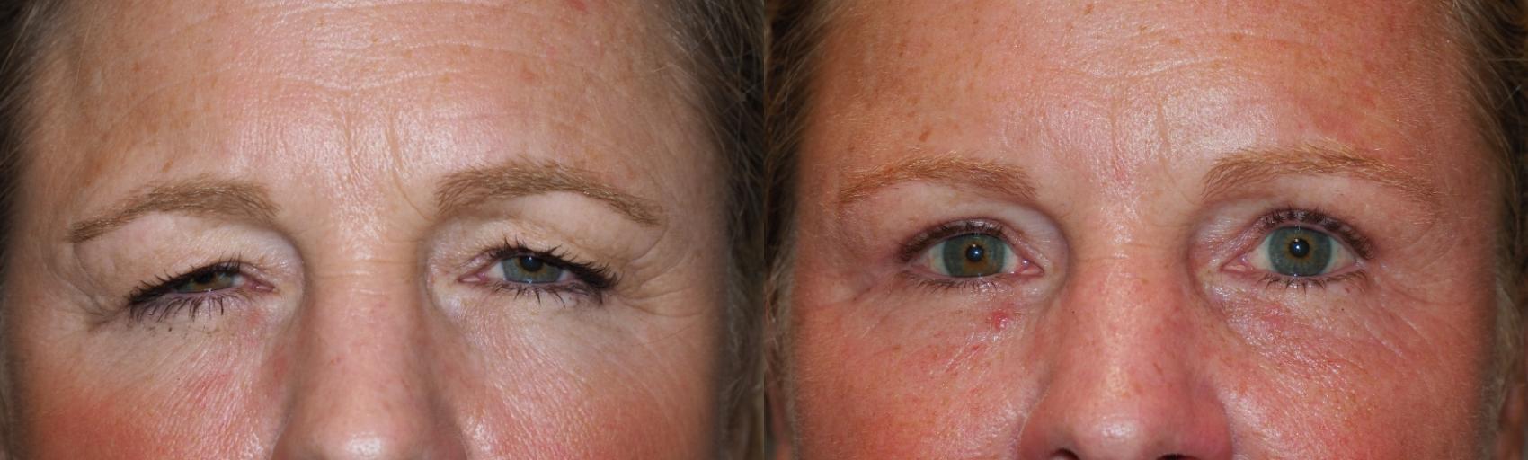 Eyelid Surgery Before & After Photo | San Francisco, CA | Kaiser Permanente Cosmetic Services