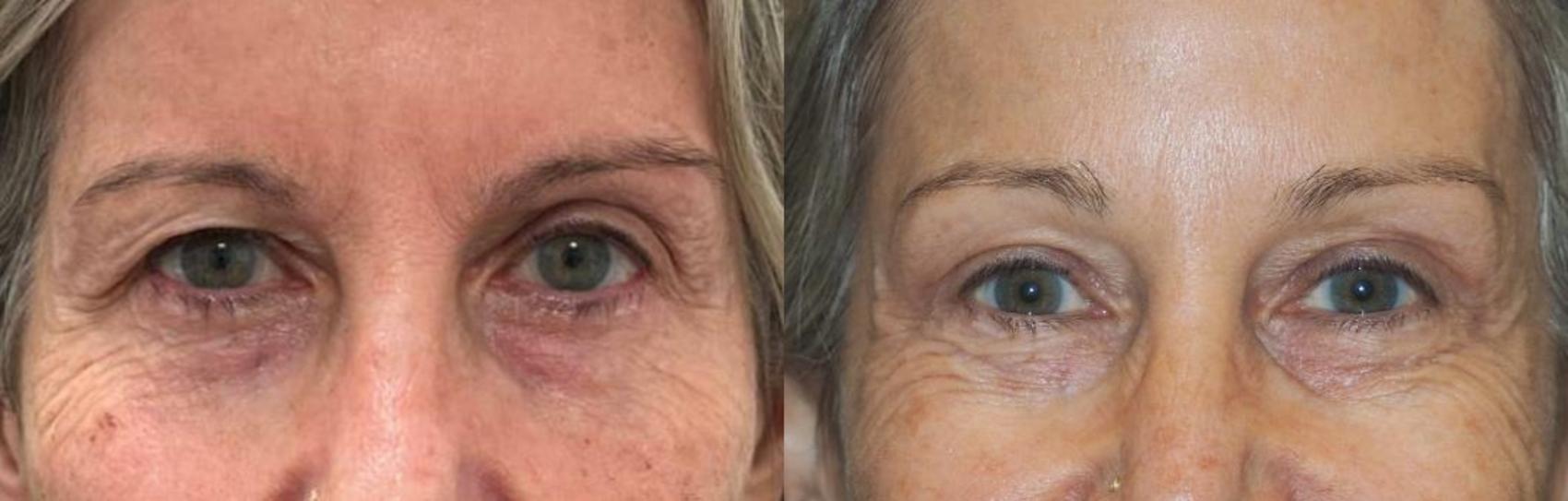 Eyelid Surgery Before & After Photo | San Francisco, CA | Kaiser Permanente Cosmetic Services