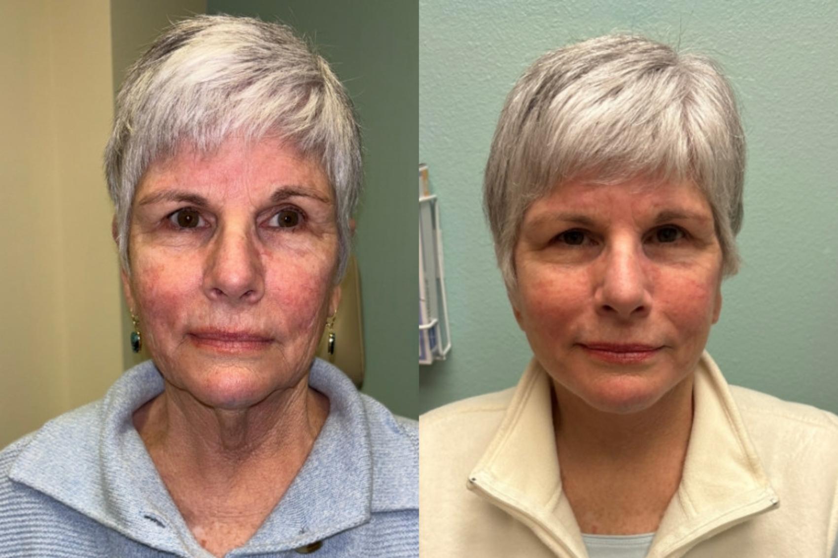 Facelift Before & After Photo | San Francisco, CA | Kaiser Permanente Cosmetic Services