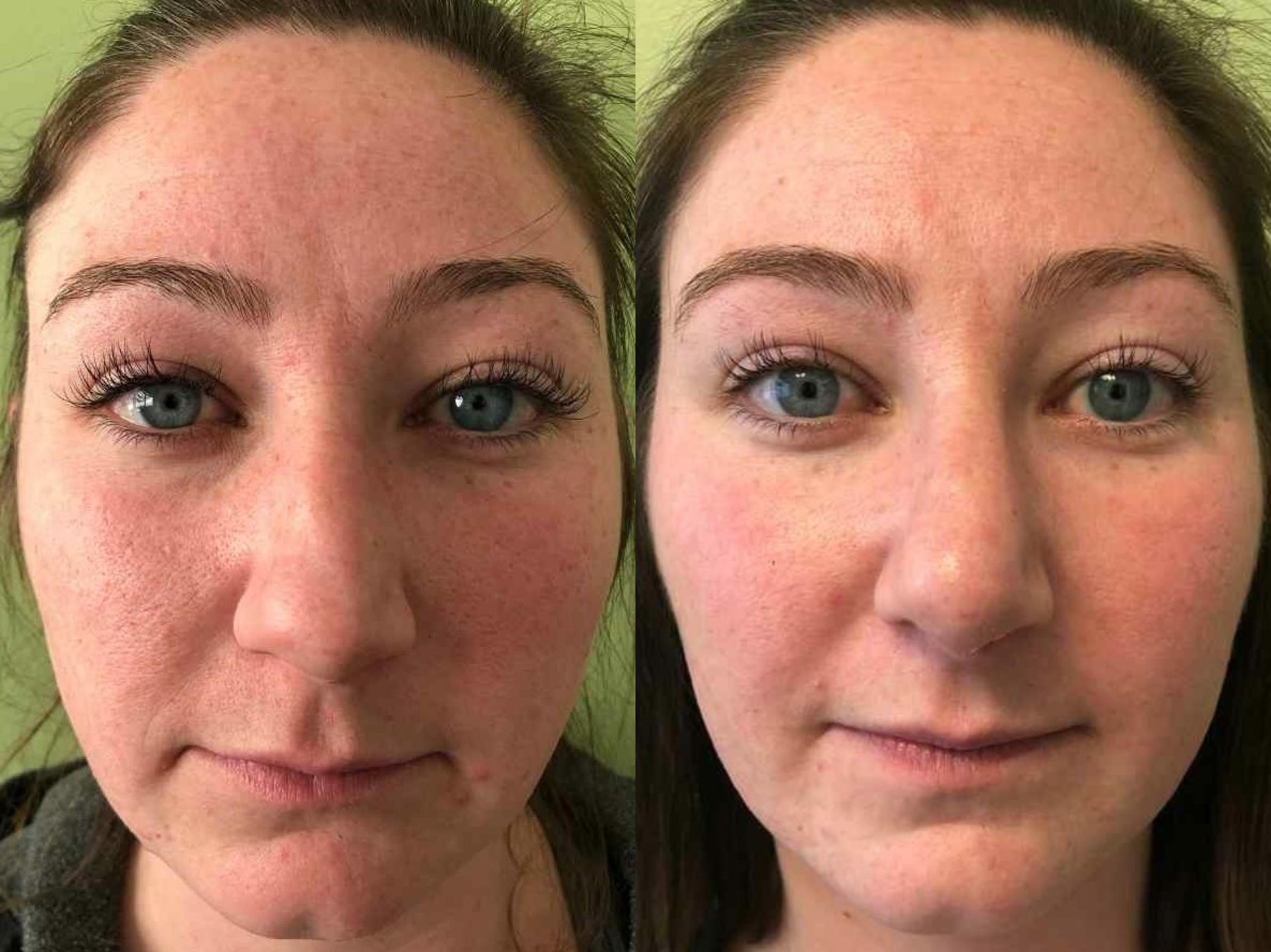 Nose Surgery Before & After Photo | San Francisco, CA | Kaiser Permanente Cosmetic Services