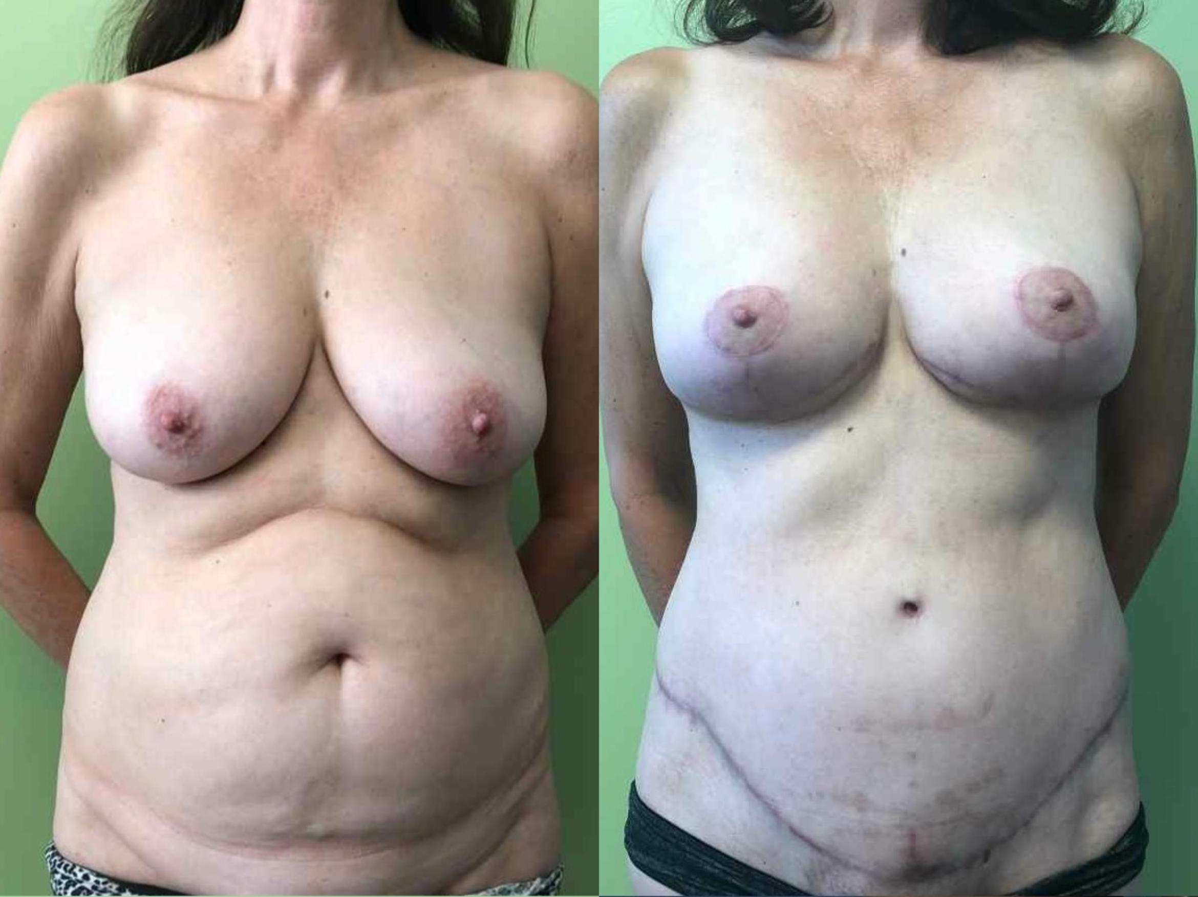 Tummy Tuck Before & After Photo | San Francisco, CA | Kaiser Permanente Cosmetic Services