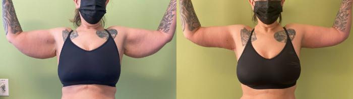 Arm Lift Before & After Photo | San Francisco, CA | Kaiser Permanente Cosmetic Services