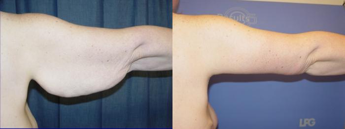 Arm Lift Before & After Photo | San Francisco, CA | Kaiser Permanente Cosmetic Services