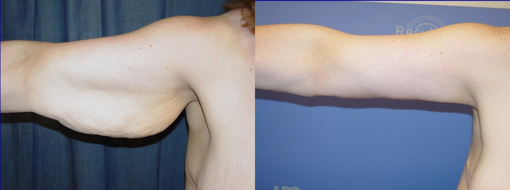 Arm Lift Before & After Photo | San Francisco, CA | Kaiser Permanente Cosmetic Services