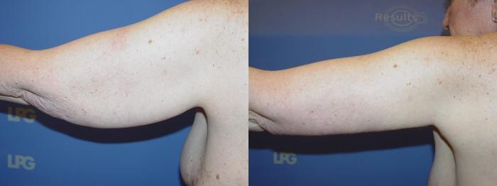 Arm Lift Before & After Photo | San Francisco, CA | Kaiser Permanente Cosmetic Services