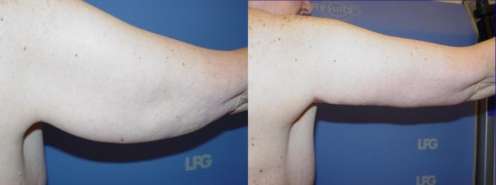 Arm Lift Before & After Photo | San Francisco, CA | Kaiser Permanente Cosmetic Services