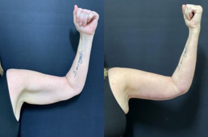 Arm Lift Before & After Photo | San Francisco, CA | Kaiser Permanente Cosmetic Services