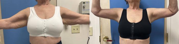 Arm Lift Before & After Photo | San Francisco, CA | Kaiser Permanente Cosmetic Services