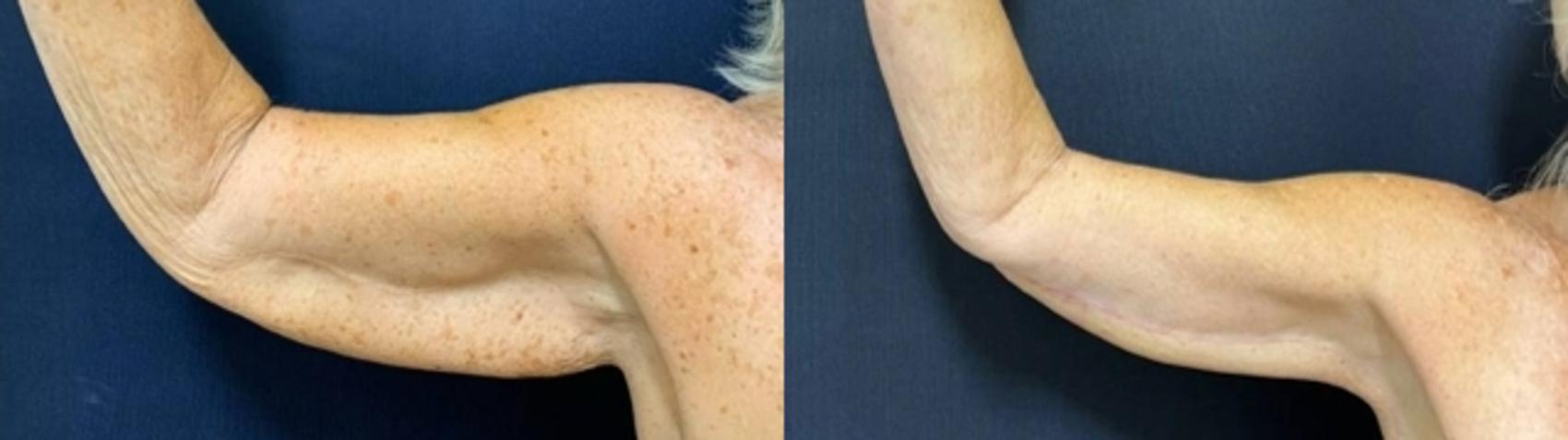 Arm Lift Before & After Photo | San Francisco, CA | Kaiser Permanente Cosmetic Services