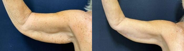 Arm Lift Before & After Photo | San Francisco, CA | Kaiser Permanente Cosmetic Services