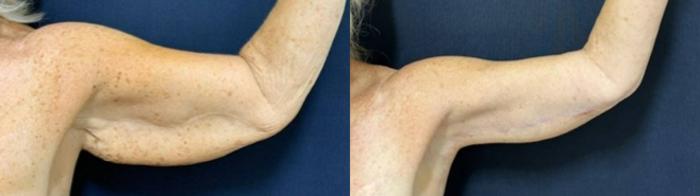 Arm Lift Before & After Photo | San Francisco, CA | Kaiser Permanente Cosmetic Services