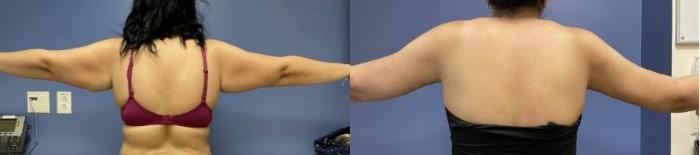 Arm Lift Before & After Photo | San Francisco, CA | Kaiser Permanente Cosmetic Services
