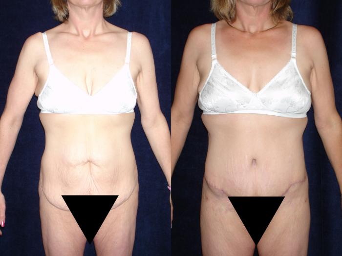 Body Contouring Before & After Photo | San Francisco, CA | Kaiser Permanente Cosmetic Services