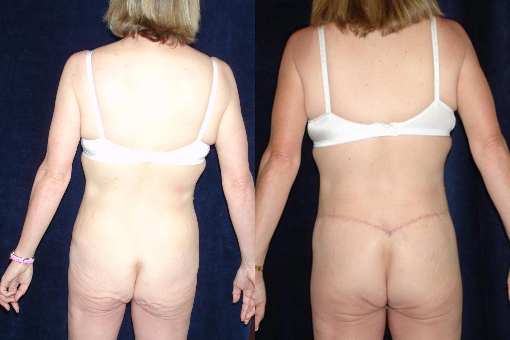 Body Contouring Before & After Photo | San Francisco, CA | Kaiser Permanente Cosmetic Services
