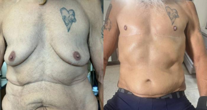 Body Contouring Before & After Photo | San Francisco, CA | Kaiser Permanente Cosmetic Services