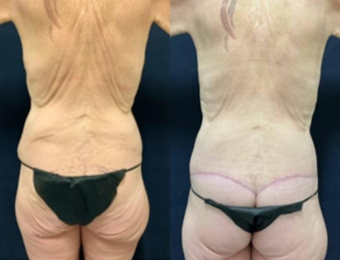 Body Contouring Before & After Photo | San Francisco, CA | Kaiser Permanente Cosmetic Services