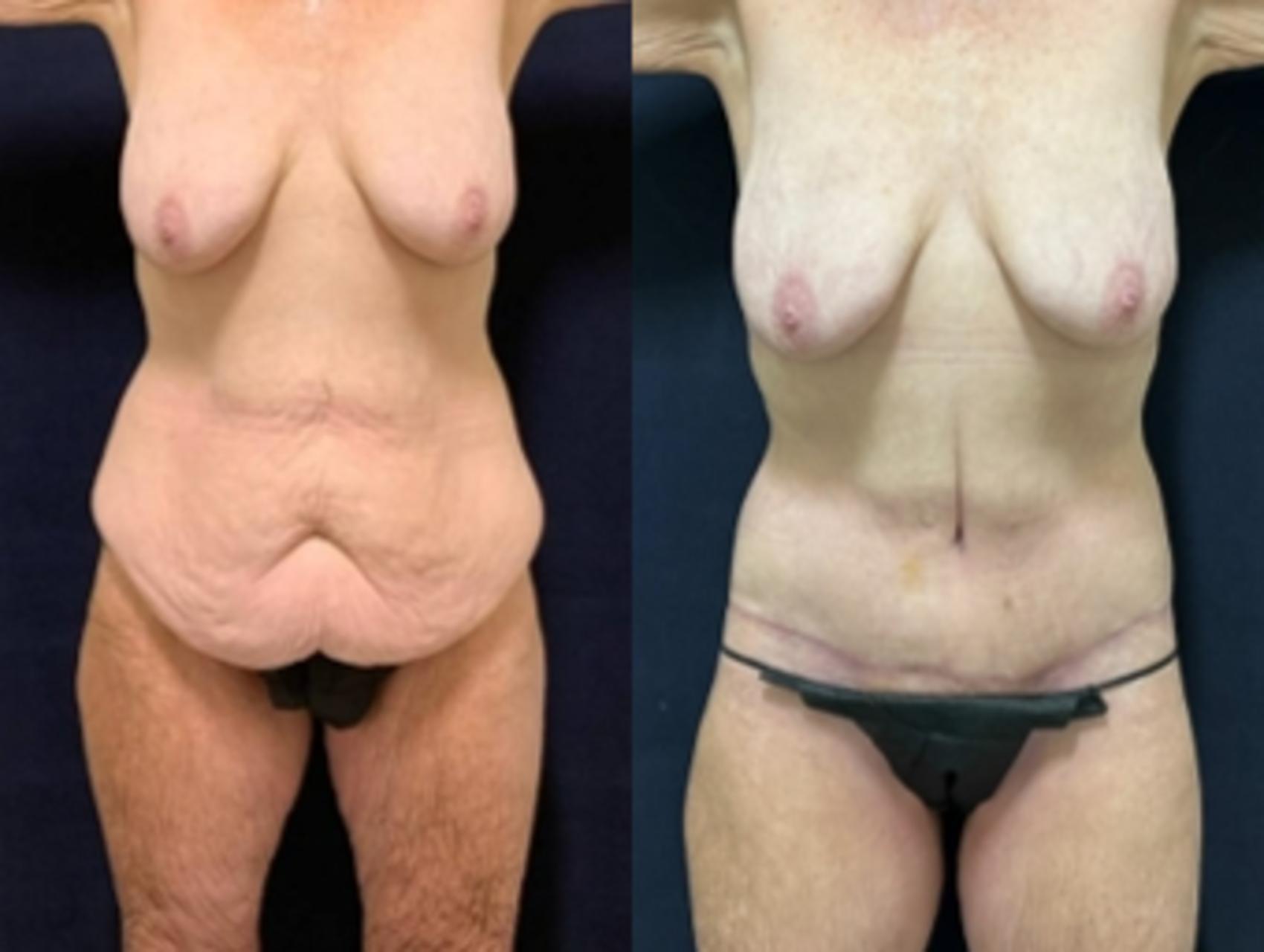 Body Contouring Before & After Photo | San Francisco, CA | Kaiser Permanente Cosmetic Services