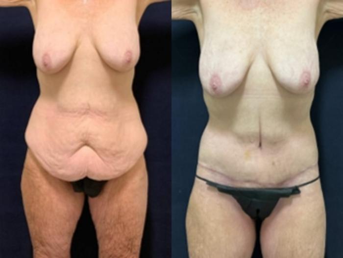 Body Contouring Before & After Photo | San Francisco, CA | Kaiser Permanente Cosmetic Services