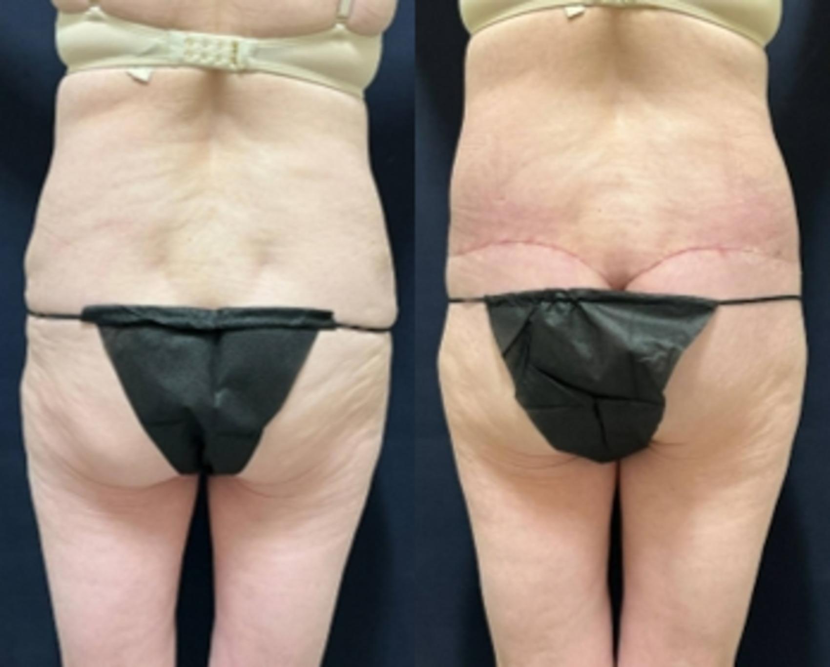 Body Contouring Before & After Photo | San Francisco, CA | Kaiser Permanente Cosmetic Services