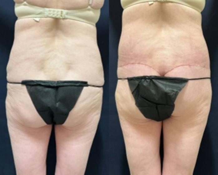 Body Contouring Before & After Photo | San Francisco, CA | Kaiser Permanente Cosmetic Services