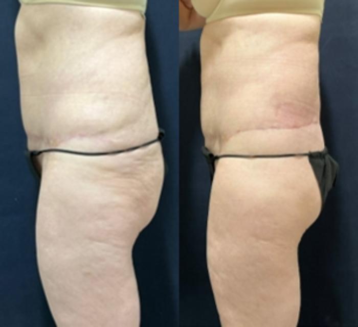 Body Contouring Before & After Photo | San Francisco, CA | Kaiser Permanente Cosmetic Services