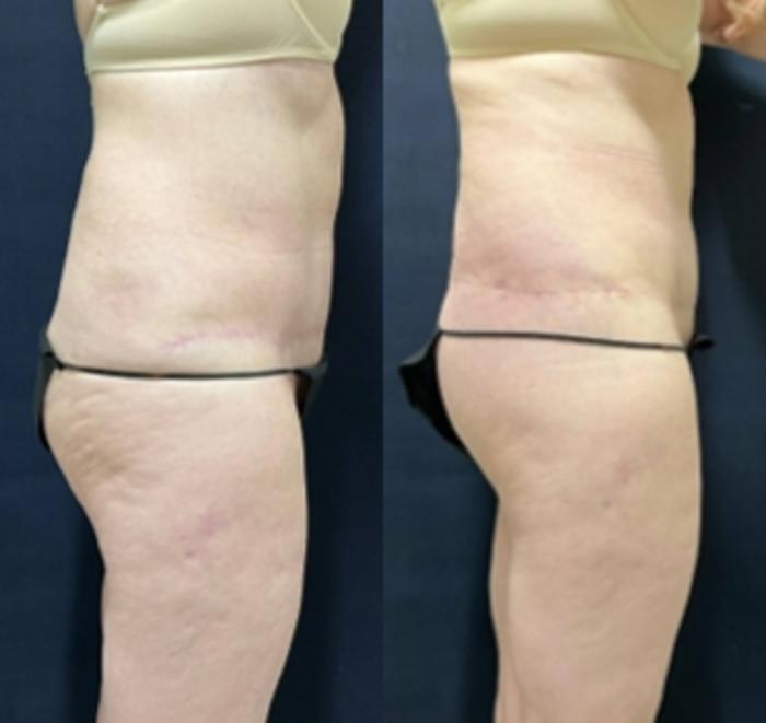 Body Contouring Before & After Photo | San Francisco, CA | Kaiser Permanente Cosmetic Services