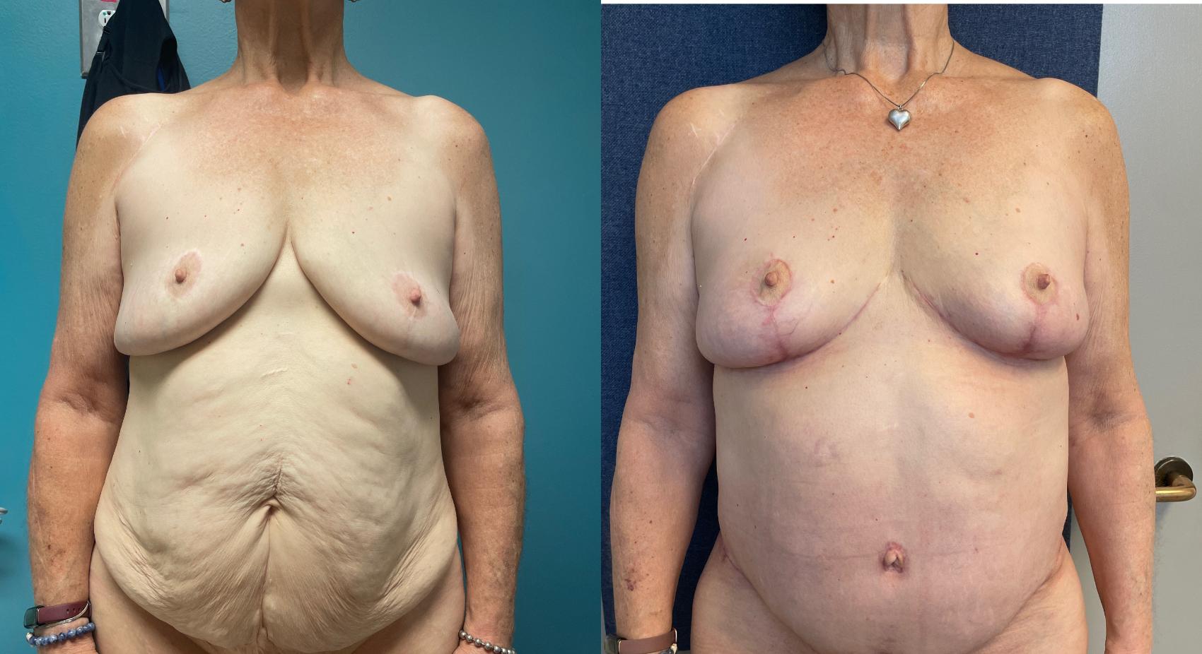 Breast Augmentation Before & After Photo | San Francisco, CA | Kaiser Permanente Cosmetic Services