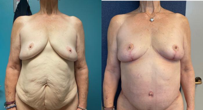Breast Augmentation Before & After Photo | San Francisco, CA | Kaiser Permanente Cosmetic Services