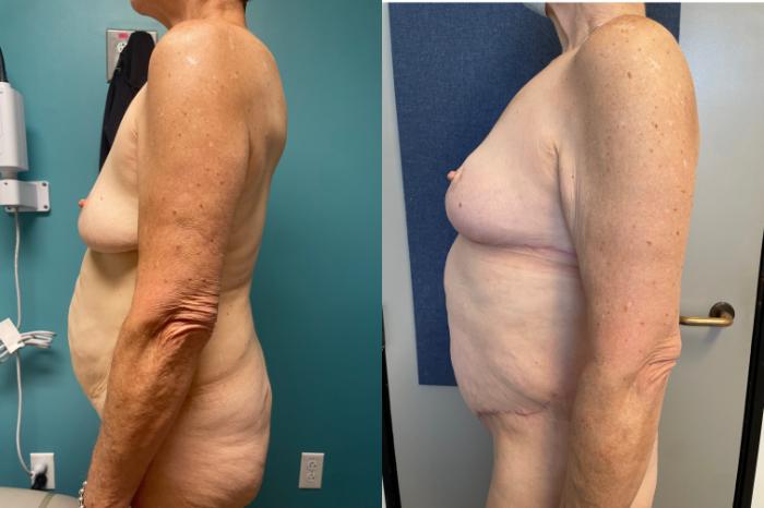 Breast Augmentation Before & After Photo | San Francisco, CA | Kaiser Permanente Cosmetic Services