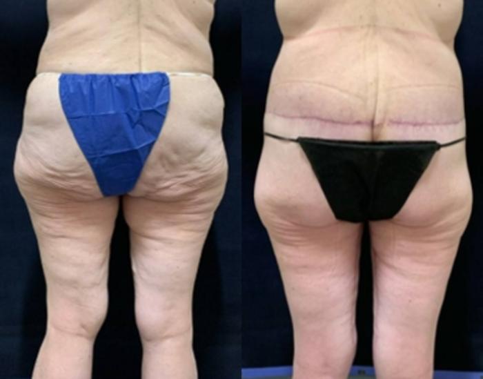Body Contouring Before & After Photo | San Francisco, CA | Kaiser Permanente Cosmetic Services