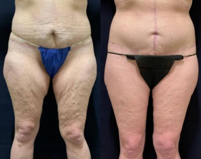 Body Contouring Before & After Photo | San Francisco, CA | Kaiser Permanente Cosmetic Services