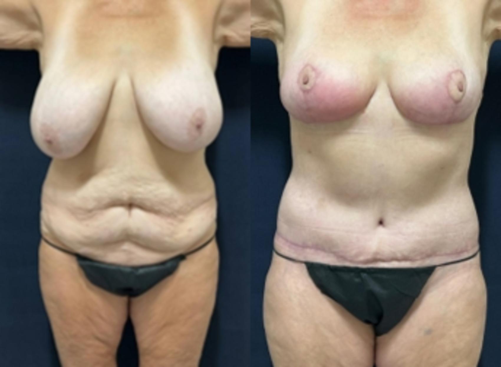 Body Contouring Before & After Photo | San Francisco, CA | Kaiser Permanente Cosmetic Services