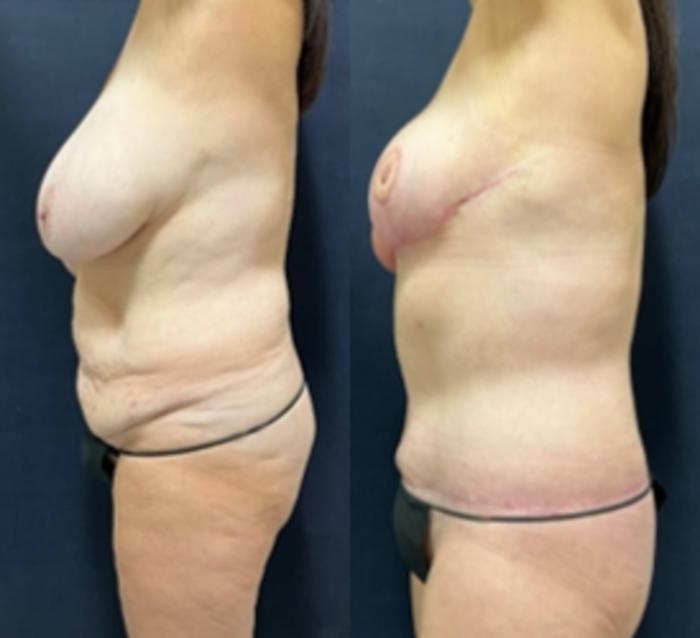 Body Contouring Before & After Photo | San Francisco, CA | Kaiser Permanente Cosmetic Services