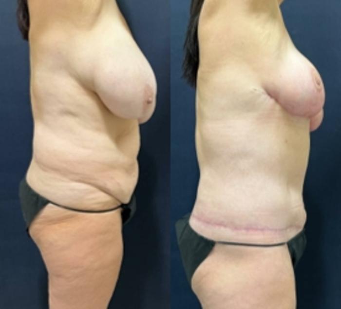 Body Contouring Before & After Photo | San Francisco, CA | Kaiser Permanente Cosmetic Services