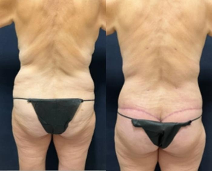 Body Contouring Before & After Photo | San Francisco, CA | Kaiser Permanente Cosmetic Services