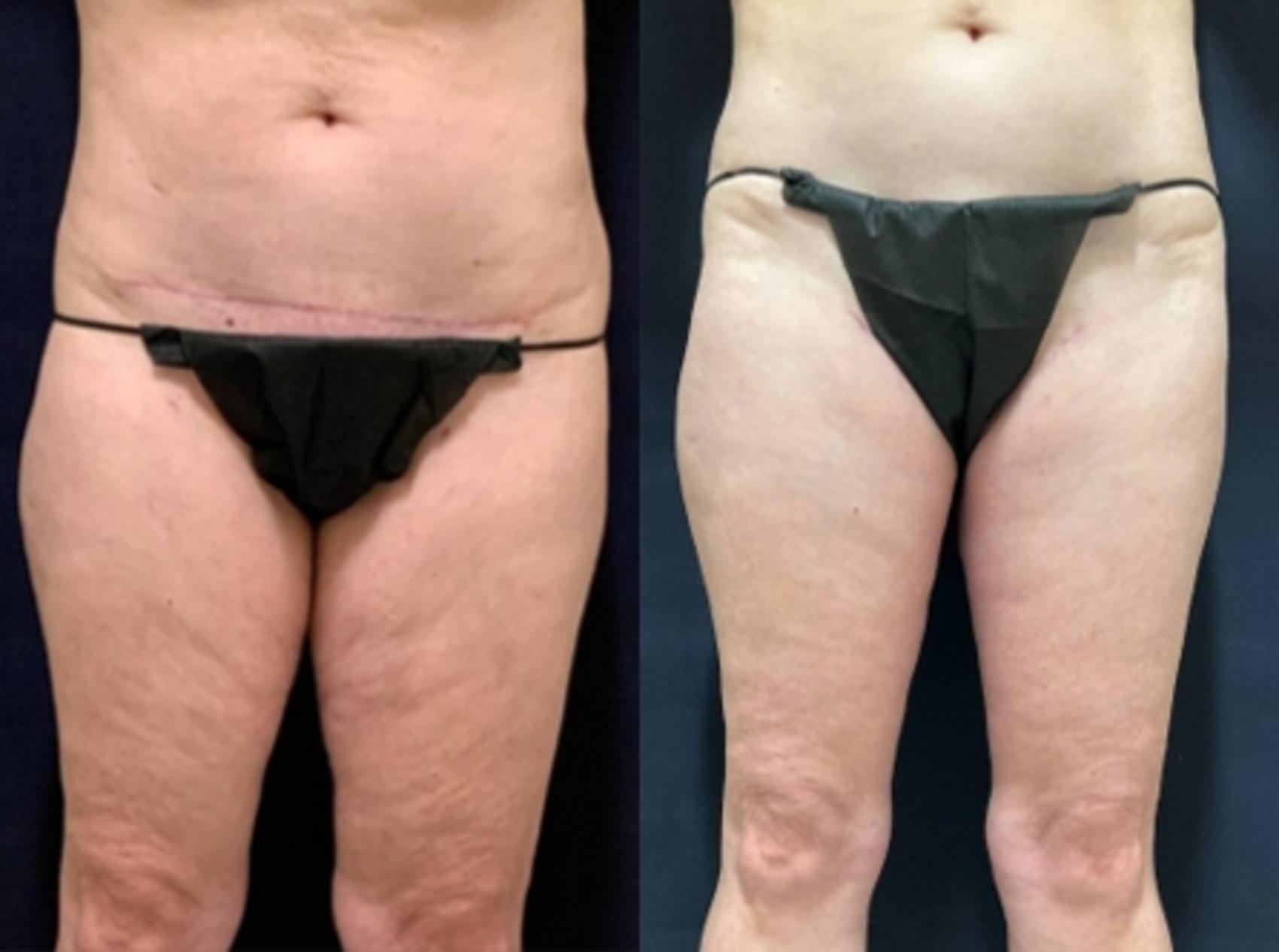 Body Contouring Before & After Photo | San Francisco, CA | Kaiser Permanente Cosmetic Services