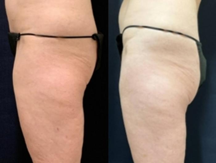 Body Contouring Before & After Photo | San Francisco, CA | Kaiser Permanente Cosmetic Services