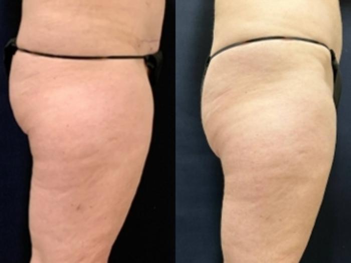 Body Contouring Before & After Photo | San Francisco, CA | Kaiser Permanente Cosmetic Services