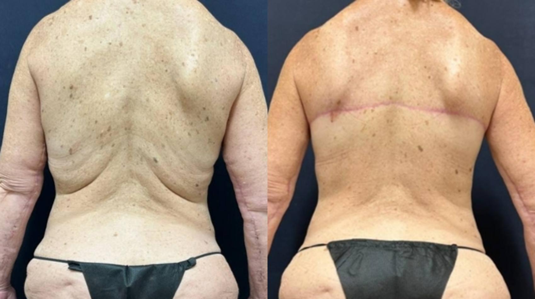 Body Contouring Before & After Photo | San Francisco, CA | Kaiser Permanente Cosmetic Services
