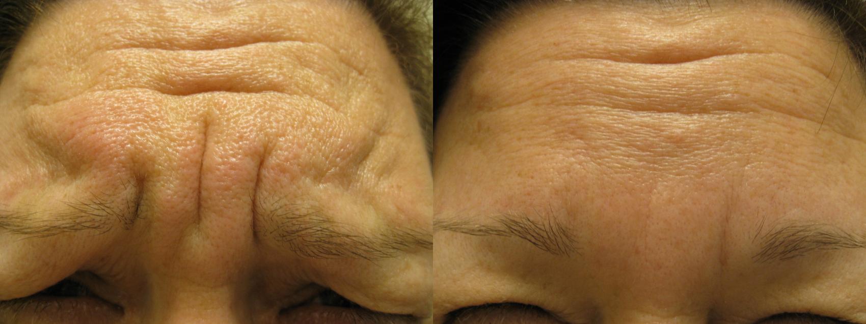BOTOX® Cosmetic and Dysport® Before & After Photo | San Francisco, CA | Kaiser Permanente Cosmetic Services