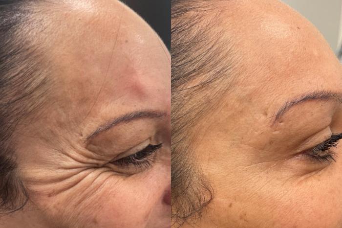 BOTOX® Cosmetic and Dysport® Before & After Photo | San Francisco, CA | Kaiser Permanente Cosmetic Services