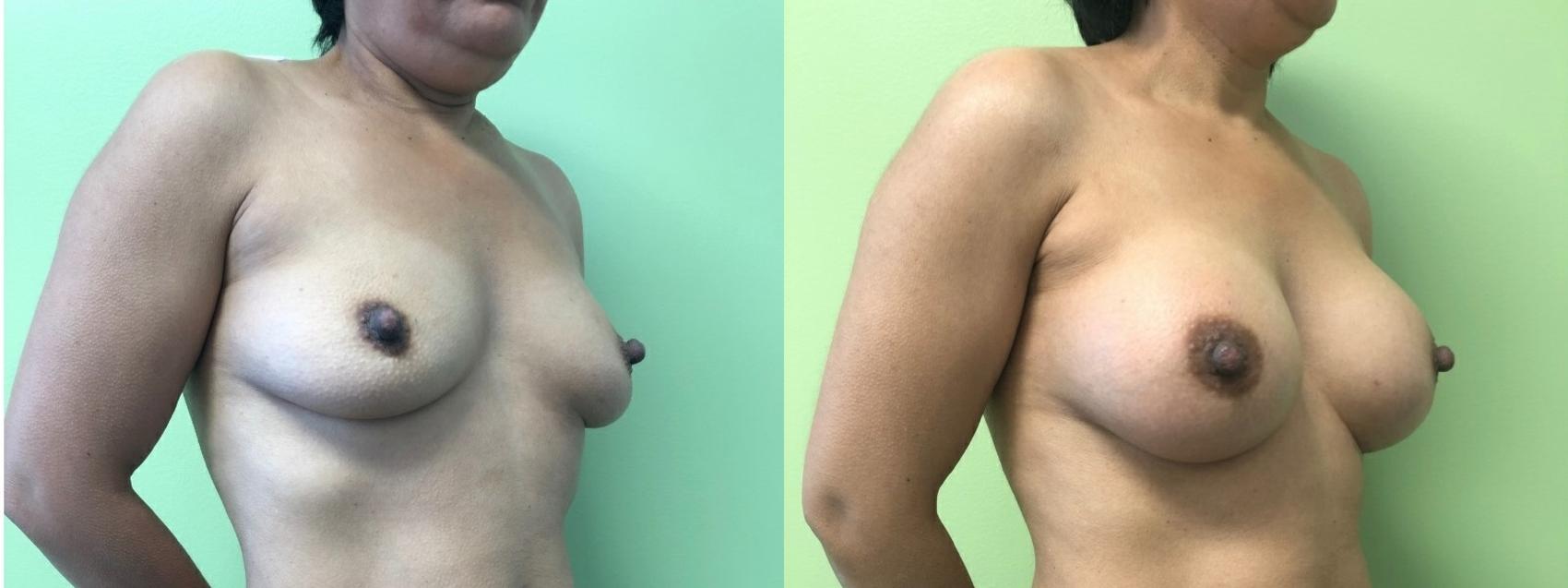 Breast Augmentation Before & After Photo | San Francisco, CA | Kaiser Permanente Cosmetic Services
