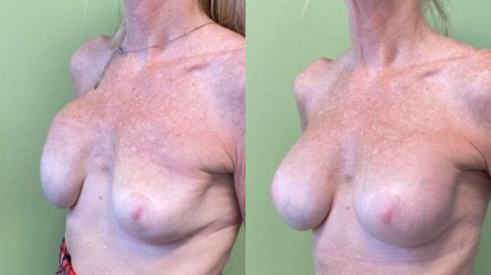 Breast Augmentation Before & After Photo | San Francisco, CA | Kaiser Permanente Cosmetic Services