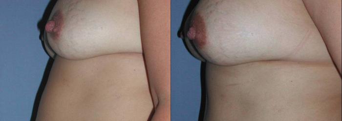 Breast Augmentation Before & After Photo | San Francisco, CA | Kaiser Permanente Cosmetic Services