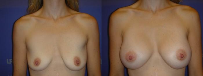 Breast Augmentation Before & After Photo | San Francisco, CA | Kaiser Permanente Cosmetic Services